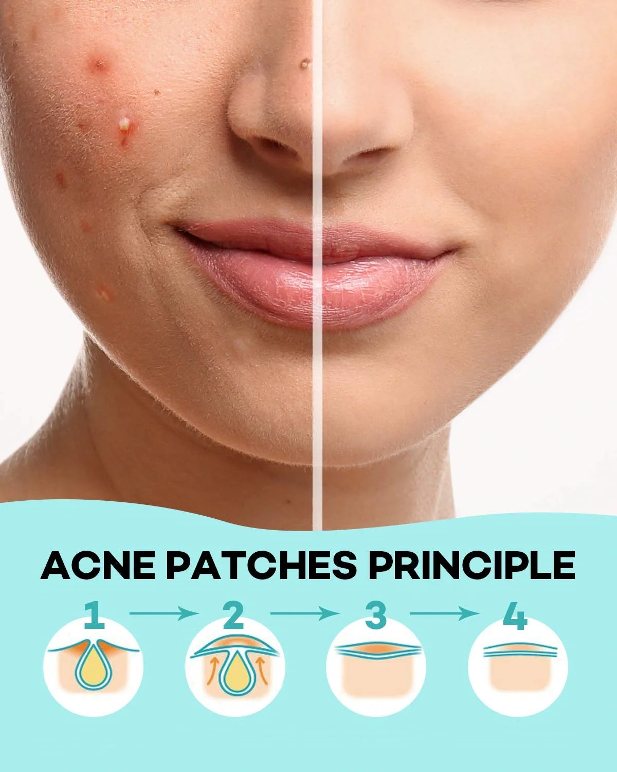 864 Day and Night Acne Patches - Gentle and non-irritating acne patches to clear acne and cover blemishes - 396 Day and Night Ro